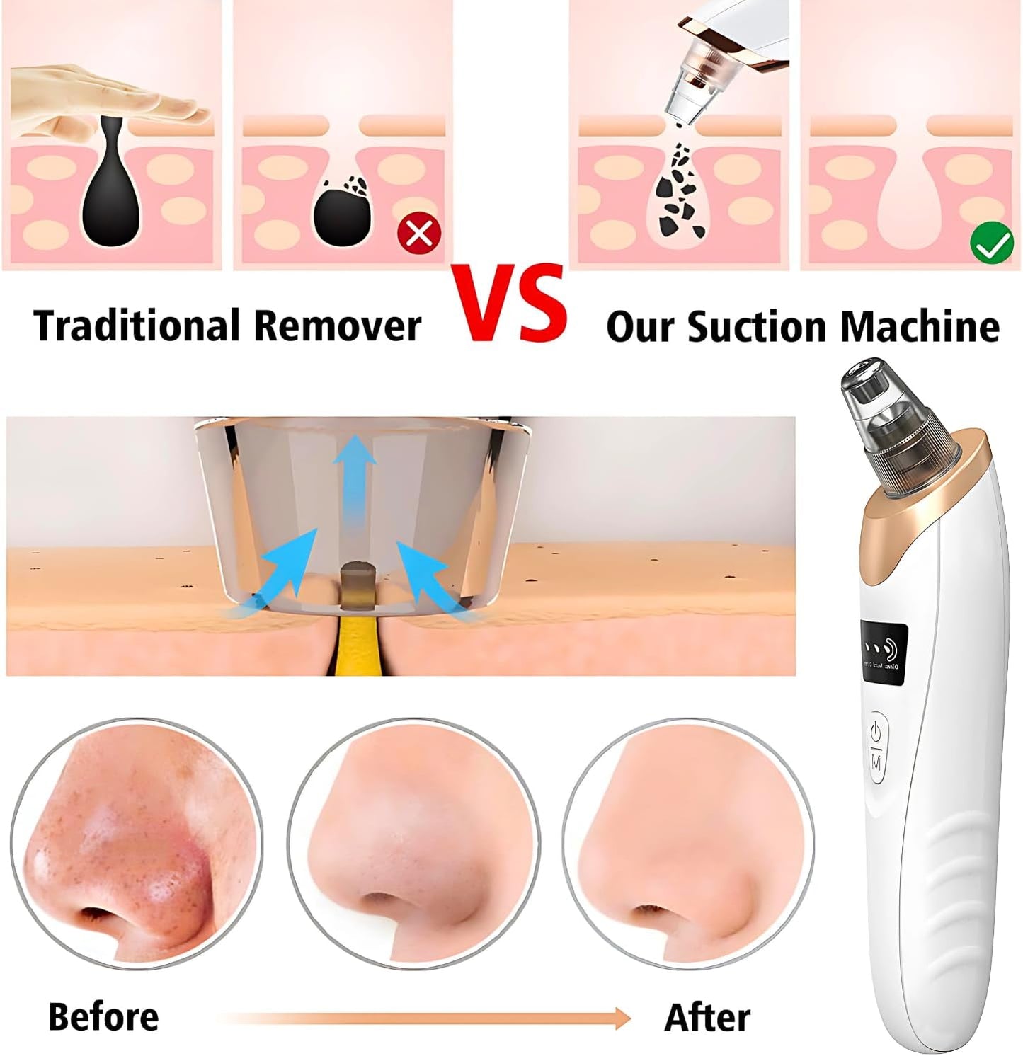 Blackhead Remover Vacuum